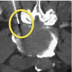 Ozonoterapia intraforaminale 