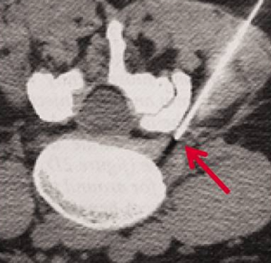 Ozonoterapia intraforaminale- ozonoterapia rx guidata a Milano