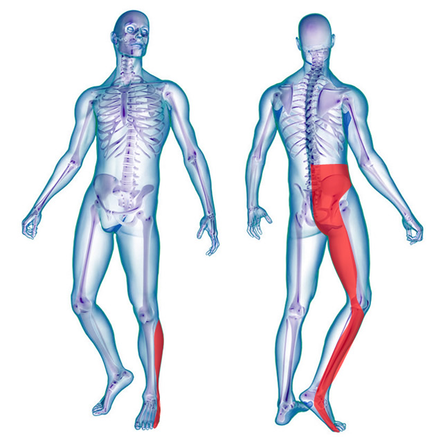 lombosciatalgia e sciatalgia