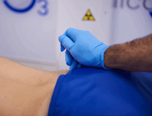 Ozonoterapia per la cruralgia: una soluzione efficace