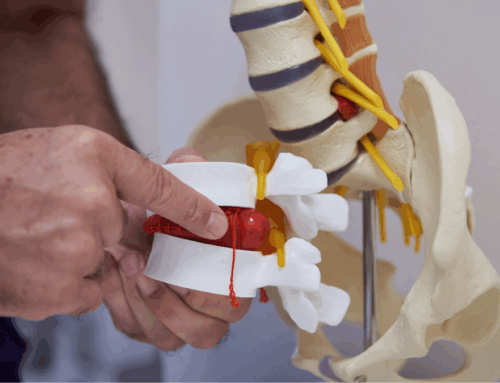 Sciatica e ozonoterapia: un trattamento sicuro ed efficace