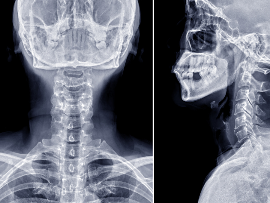 Medico che esegue una radiografia della colonna cervicale per diagnosticare la cervicalgia.