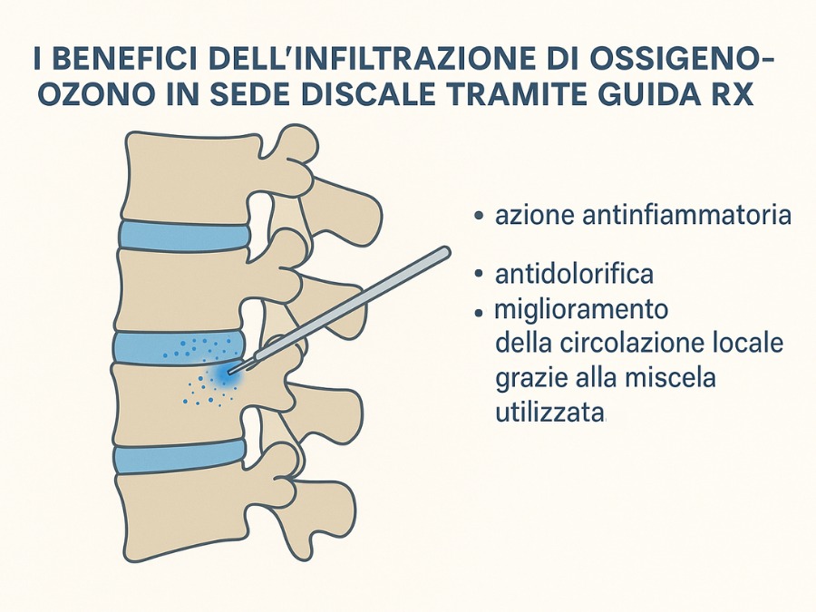 Infografica dei benefici dell’ozonoterapia RX guidata sulla colonna vertebrale.