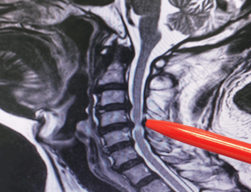 Ernia cervicale e ozonoterapia RX guidata: quando è indicata?