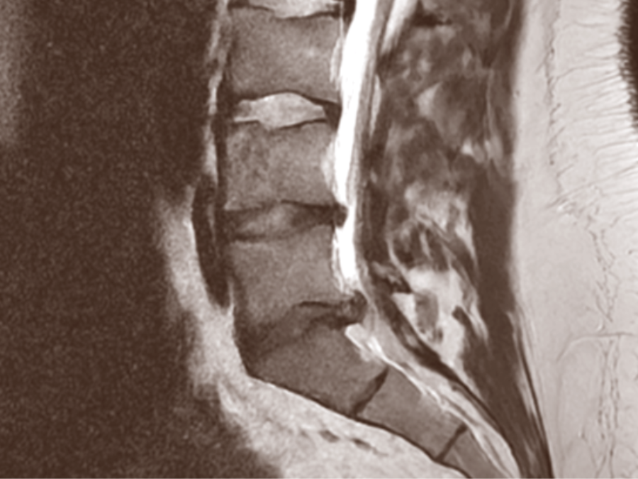Infiltrazione alla colonna vertebrale con guida radiologica durante una seduta di ozonoterapia RX guidata.