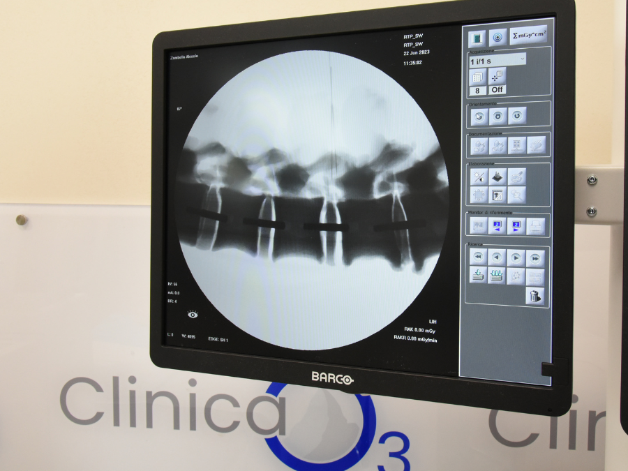 Medico esegue ozonoterapia RX guidata sulla colonna vertebrale di un paziente.