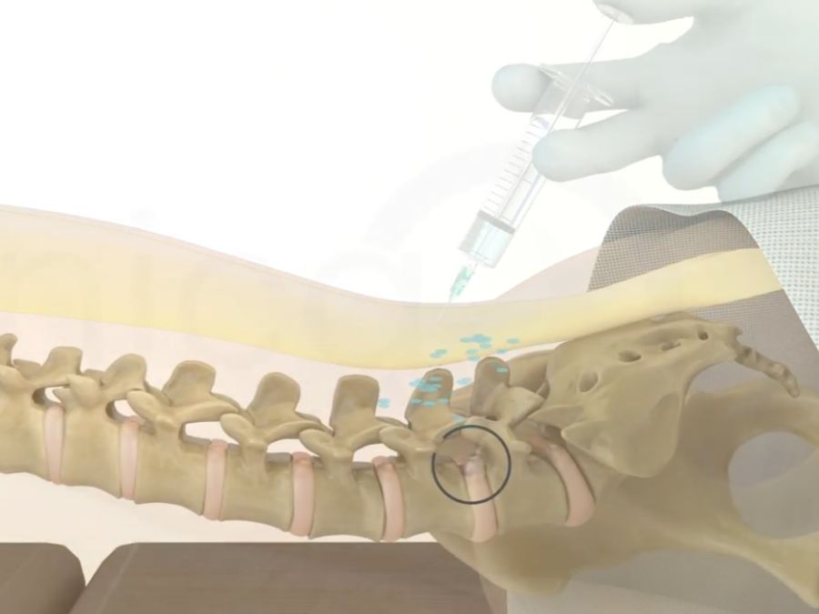 Medico che esegue infiltrazione di ozonoterapia RX guidata sulla colonna vertebrale con evidenza di ernia discale e infiammazione nervosa.