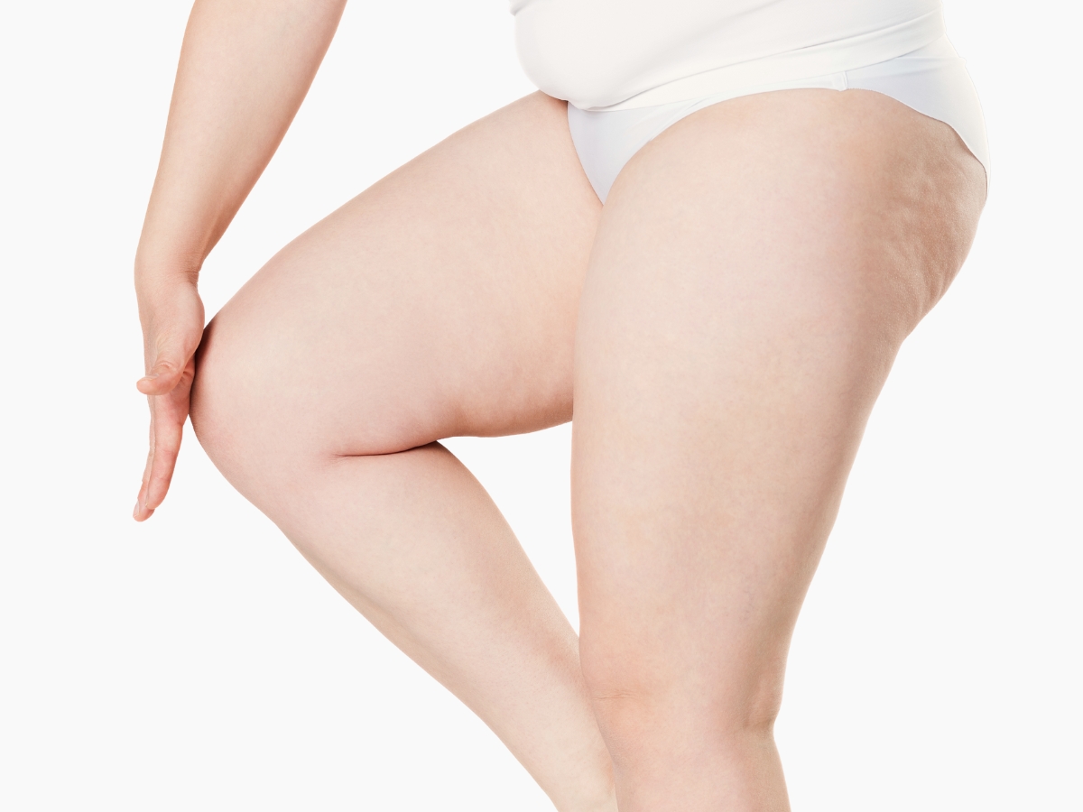 Combattere la cellulite con l'ossigeno ozonoterapia a Milano