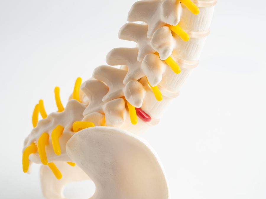 Ozonoterapia RX guidata per il trattamento dell’ernia discale lombare.