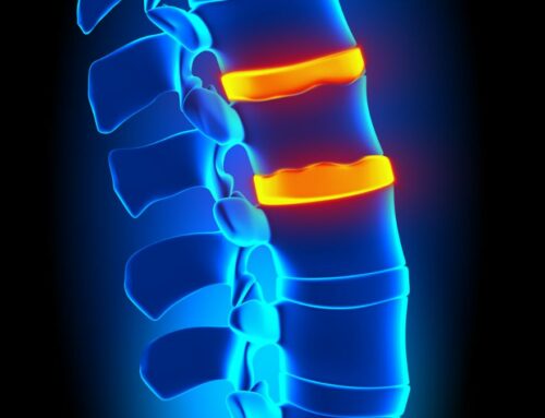 Degenerazione discale, da fisiologica a patologica:  la malattia degenerativa del disco