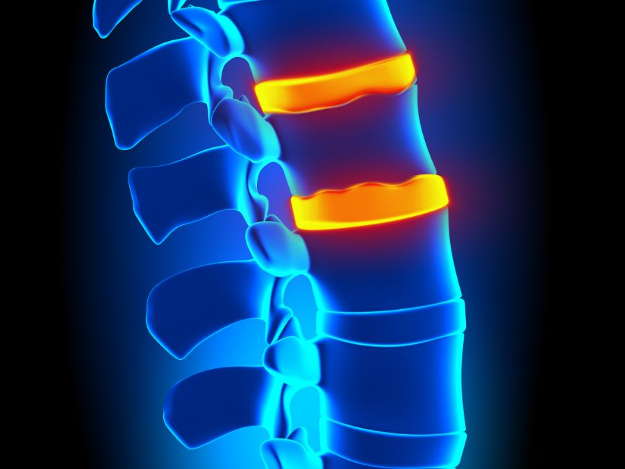Degenerazione discale della colonna vertebrale