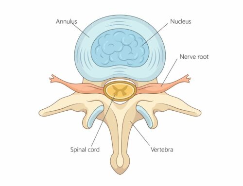Lesioni dell’anulus: cosa sono e perché possono causare dolore