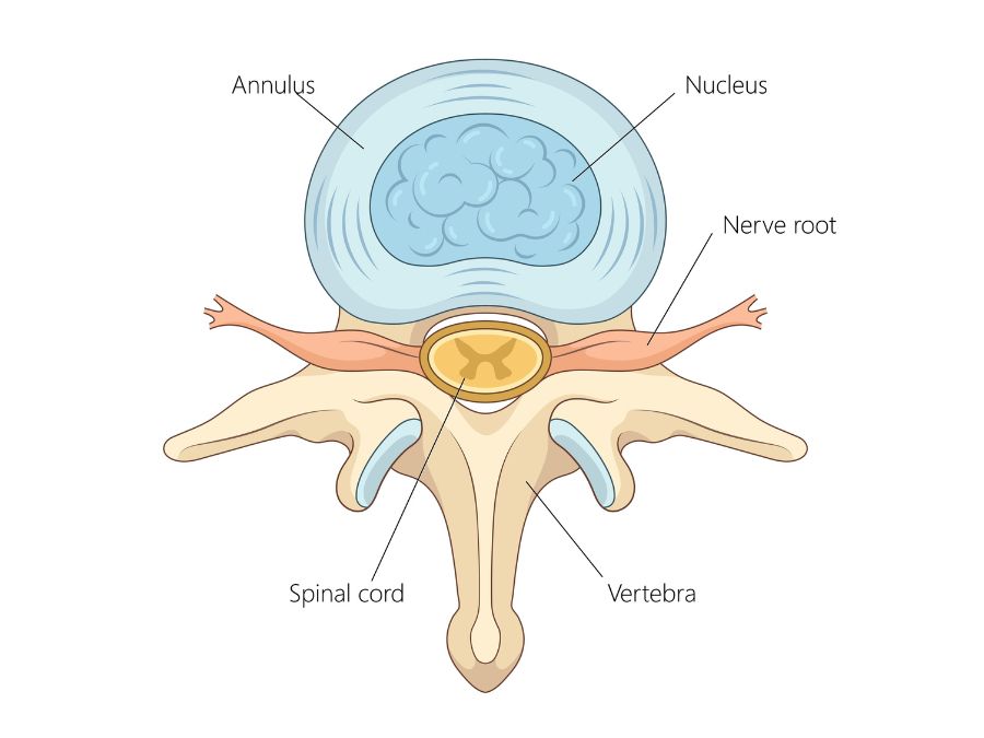 Illustrazione del disco intervertebrale