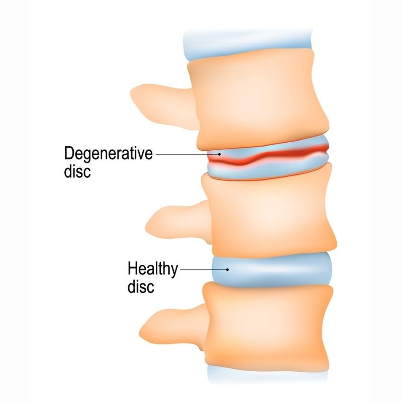 confronto tra disco intervertebrale sano e degenerato