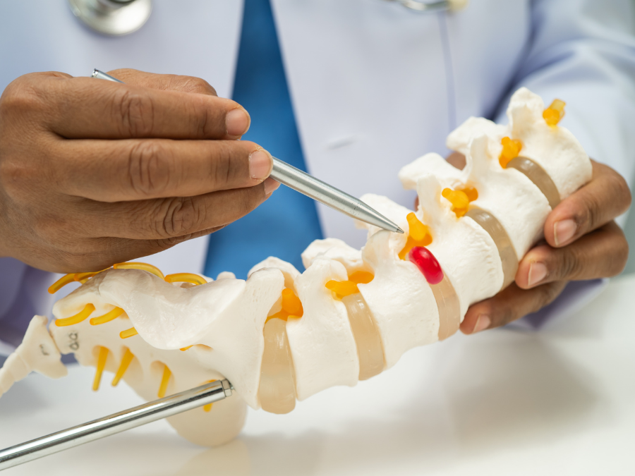 Schema della colonna vertebrale con protrusione discale e compressione delle radici nervose